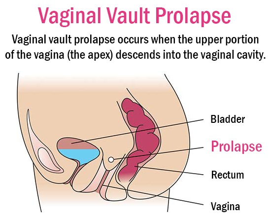 Uterine Prolapse / Displacement – Mind & Body Holistic Health Clinic