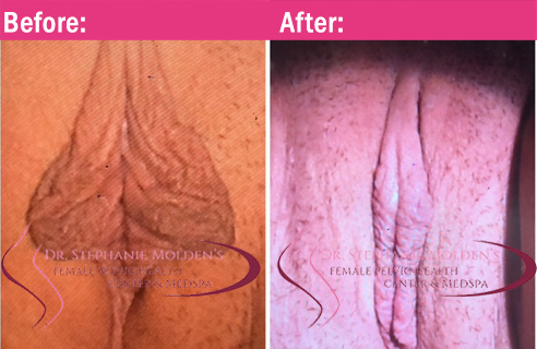 Female Pelvic Health Center (Newtown PA) - Labiaplasty Before and After