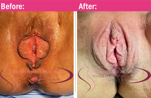 Female Pelvic Health Center (Newtown PA) - Labiaplasty Before and After