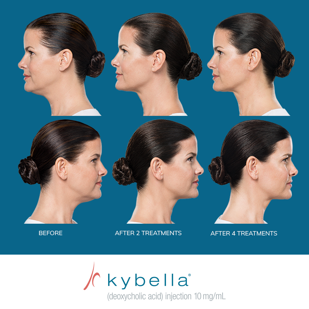 kybella